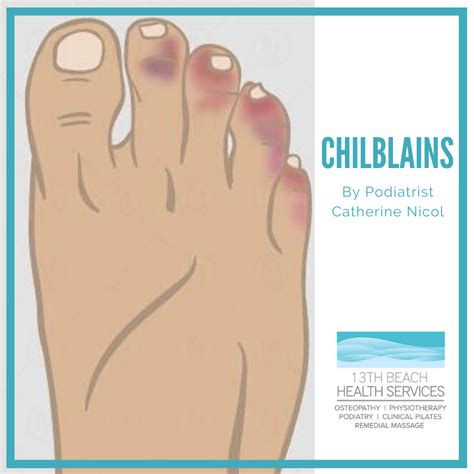 Chilblains Risks Prevention And Treatment Of Chilblains