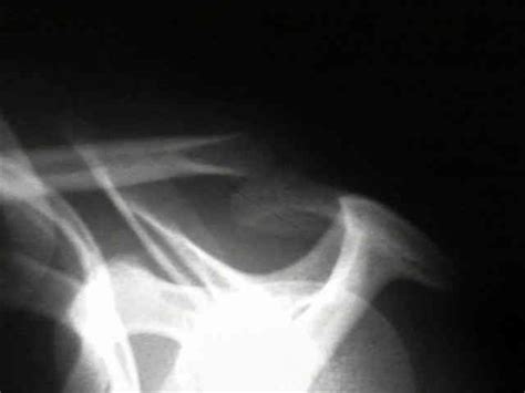 Distal Clavicle Physeal Fractures Pediatrics Orthobullets