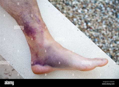 Bruised Ankle Injury With Torn Ligaments Stock Photo Royalty Free