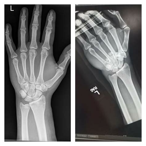 What A Normal Hand X Ray Looks Like Left And What I Managed To Do To