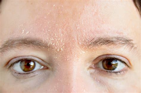 You need to apply these home remedies continuously and. Dry Skin Problems: A Comprehensive Guide | Dermatologist ...