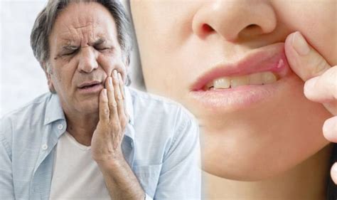 Mouth Ulcers When Sores Could Be A Sign Of Cancer Symptoms To Spot