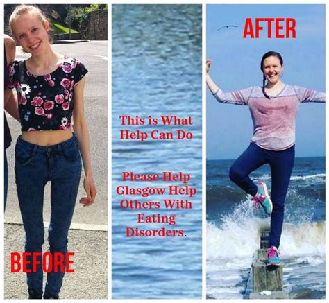 Anorexia Survivor Campaigns For Specialist Eating Disorder Unit For Glasgow Glasgow Live