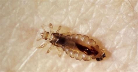 Head Lice Facts Health And Beauty
