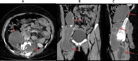 Contrast Enhanced Abdominopelvic Ct Scan Axial A Coronal B And