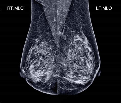 240 Mammography Lymph Nodes Stock Photos Pictures And Royalty Free