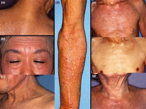 Atopic Dermatitis Eczema Skinpractice