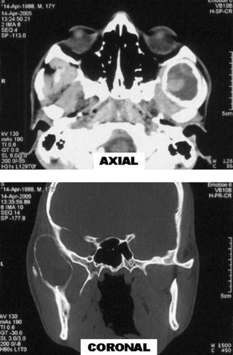 Figure 1primary Aneurysmal Bone Cyst Of Coronoid Process Open I