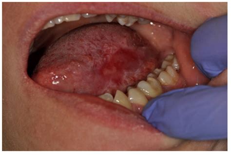 Symmetry Free Full Text Prevalence And Characteristic Of Oral