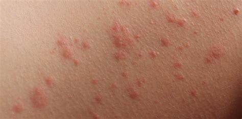 Itchy Skin Rash Pictures Causes Symptoms Treatment