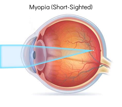 Short Sight Or Myopia What Is It And What Can You Do About It We