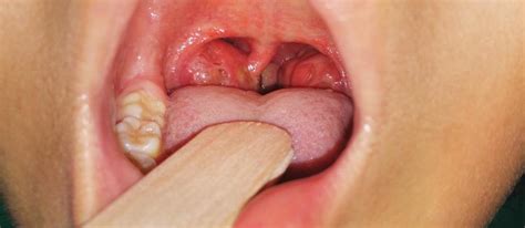 Sore Throat Signs Causes And Treatment Prodigy Ent