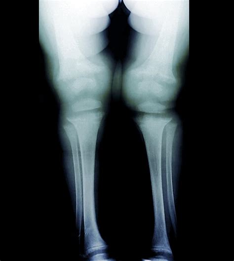 Childhood Rickets X Ray Photograph By Zephyr