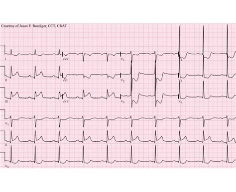 Inferoposterior Mi Ecg Guru Instructor Resources