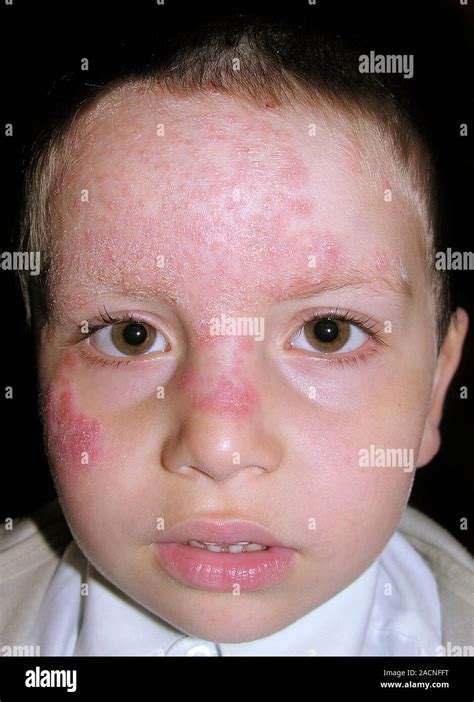 Red Patches On The Skin Of The Face In A Young Male Patient Due To