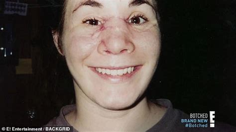 Many Photos Mother Whose Face Was Rebuilt After A Drunken Car Crash Finally Has The Nose She