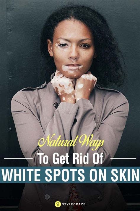 21 Natural Ways To Get Rid Of White Spots On Skin Vitiligo With