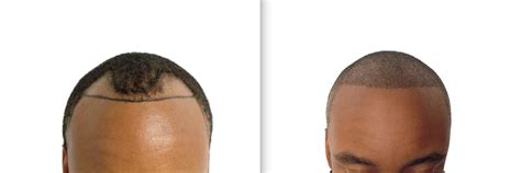 These Signs Of Balding Can Be Reversed Barber Surgeons Guild