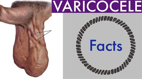 VARICOCELE हद म सब कछ YouTube