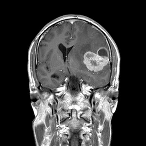 Brain Cancer Mri Scan Photograph By Du Cane Medical Imaging Ltd