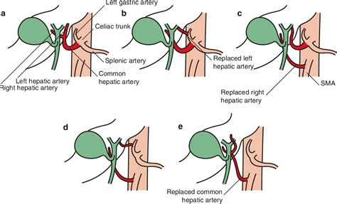 Surgery For Pancreatic And Periampullary Cancer Semantic Scholar