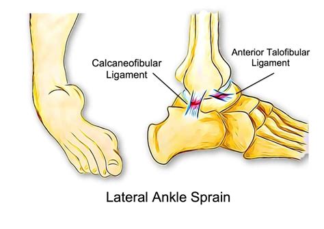 Ankle Sprains Beachbox Physiotherapy