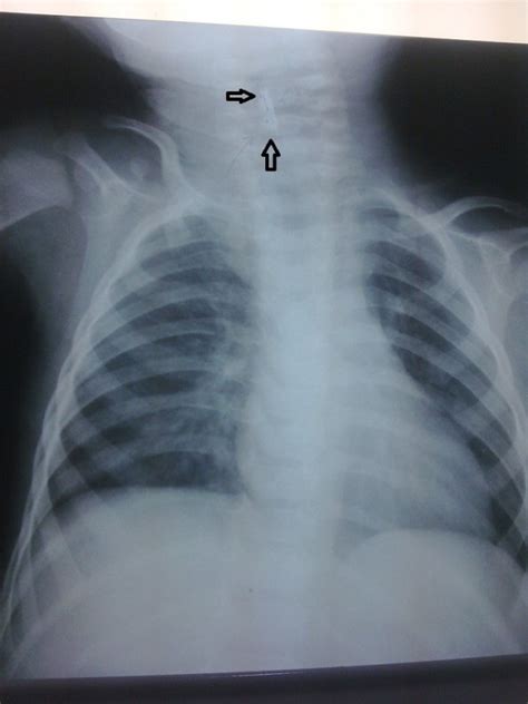 Esophageal Foreign Body Which Was Misdiagnosed As A Tracheal Foreign