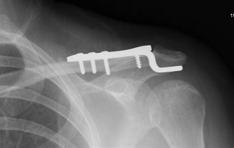 Clavicle Fractures Distal Trauma Orthobullets