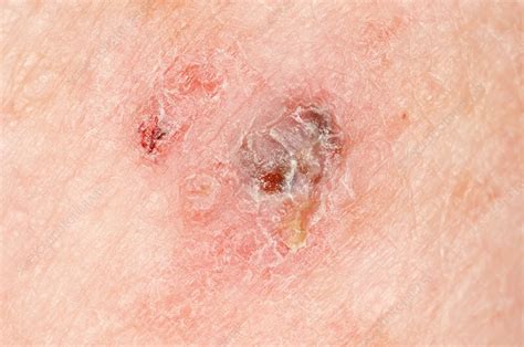 Melanoma Skin Cancer On The Arm Stock Image C009 0096 Science