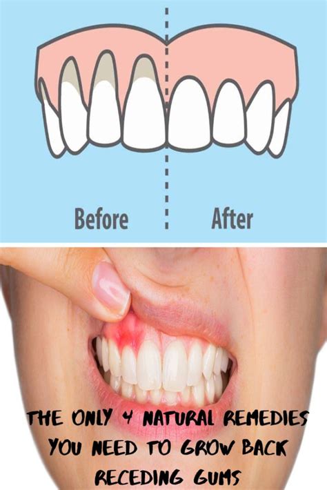 The Only 4 Natural Remedies You Need To Grow Back Receding Gums Grow
