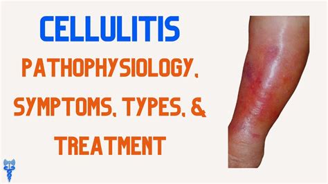 Cellulitis Pathophysiology Types Treatment Symptoms And Nursing