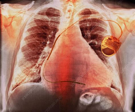 Pacemaker In Heart Disease X Ray Stock Image F0121357 Science