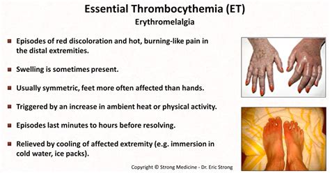 Erythromelalgia • Episodes Of Red Discoloration And Grepmed