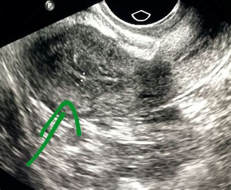 Ultrasound Of The Pelvis Shows A Normal Uterus Radiologist