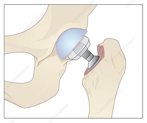 Hip Replacement Artwork Stock Image C008 5324 Science Photo Library