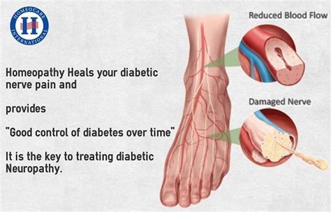 Pin On Diabetic Neuropathy