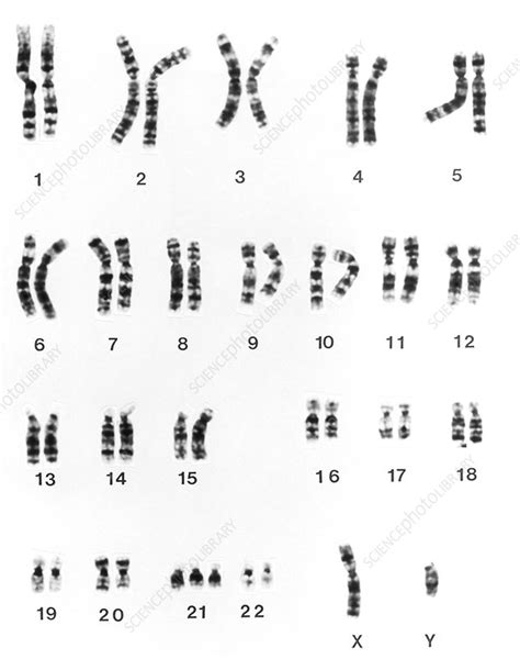 Karyotype Of Chromosomes In Downs Syndrome Stock Image M3520002 Science Photo Library