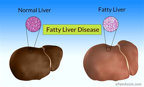 Fatty Liver Disease Food List