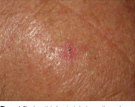 Pdf Progression Of Actinic Keratosis To Squamous Cell Carcinoma