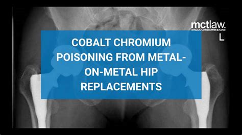 Cobalt Chromium Poisoning From Metal On Metal Hip Replacements Youtube