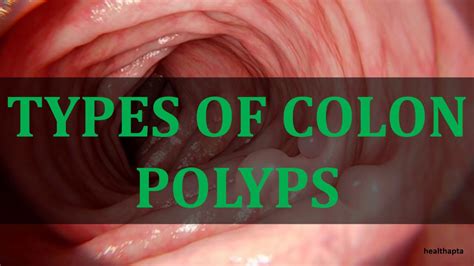 Types Of Colon Polyps Youtube