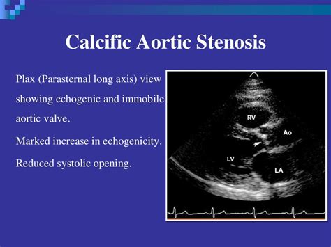 Echocardiographic Evaluation Of Aortic Stenosis