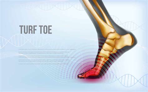 How To Treat Turf Toe Causes Symptoms And Expert Treatment Options