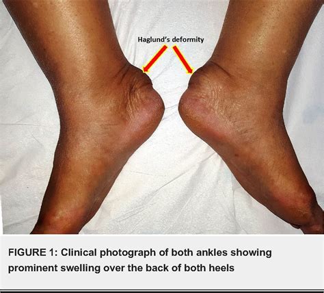Figure 1 From Haglund S Syndrome A Commonly Seen Mysterious Condition