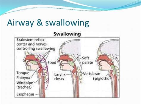 Feeding And Swallowing Difficulties Among Children With Multiple Disabi