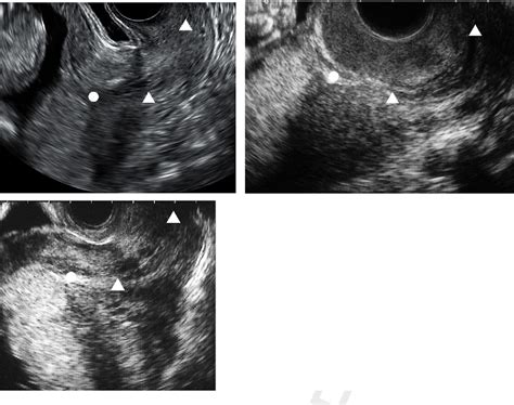 Figure 2 From Placenta Previa With Early Opening Of The Uterine Isthmus