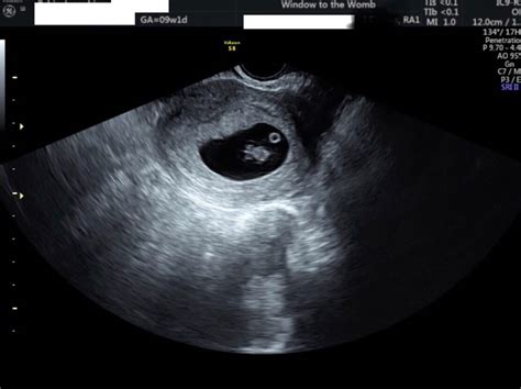 Specialist Ectopic Pregnancy Scans Firstscan At Window To The Womb