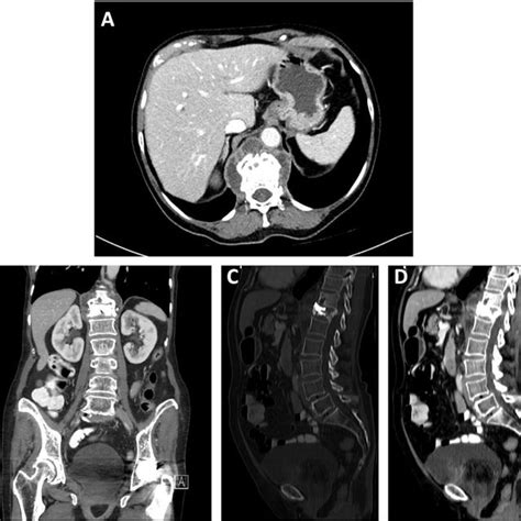 Contrast Enhanced Abdominal Images Computed Tomography Images A Axial