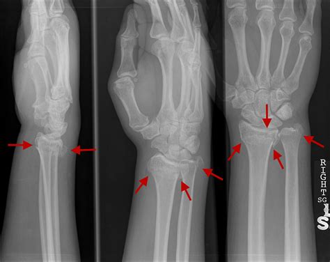 Avulsion Fracture Of Styloid Process Of Ulna
