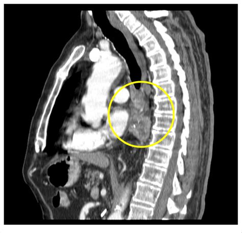 Sagittal Contrast Enhanced Computed Tomography Ct Chest Soft Tissue